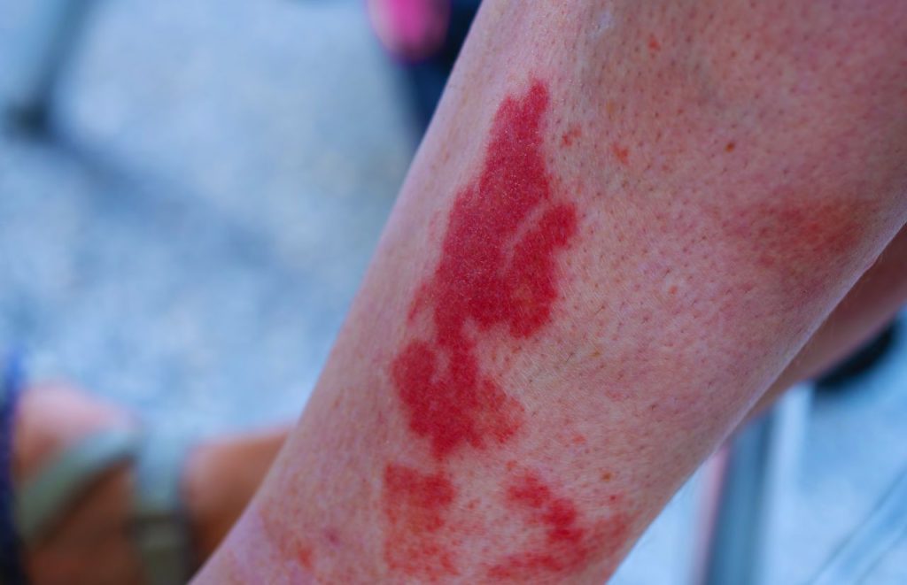 Chaffing and red rash at theme parks
